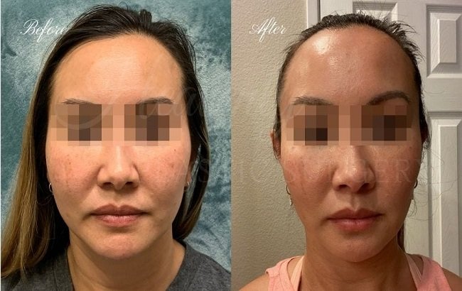 Masseter Botox Before and After