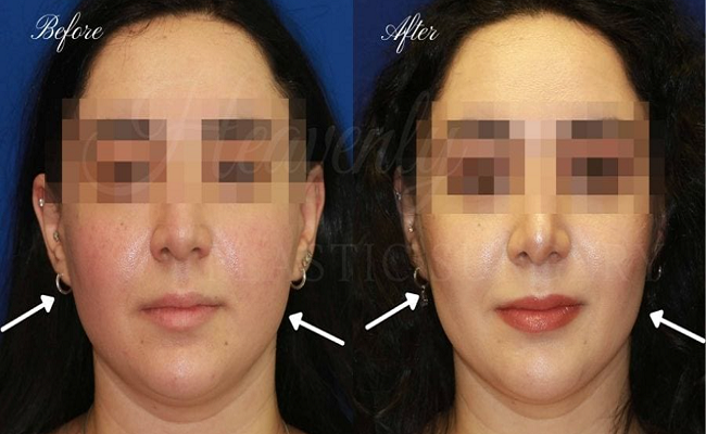 buccal fat removal before and after